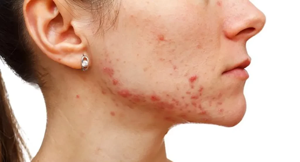 Acne