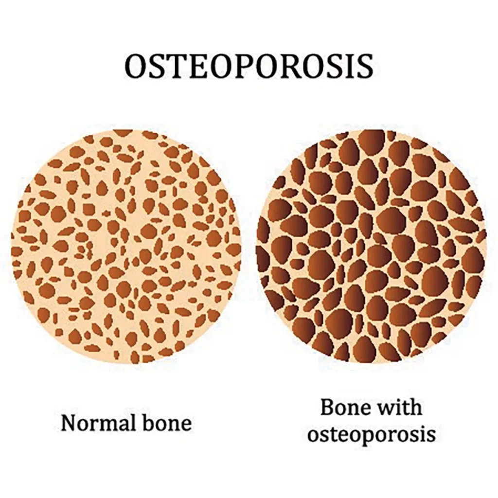 Osteoporosis