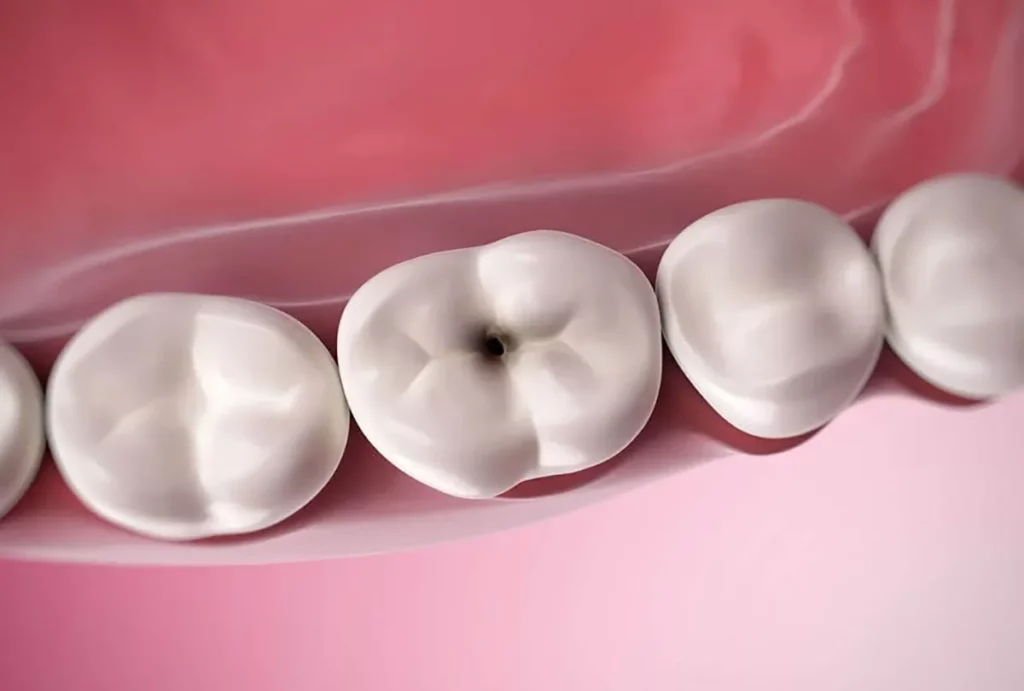 sugar cavities